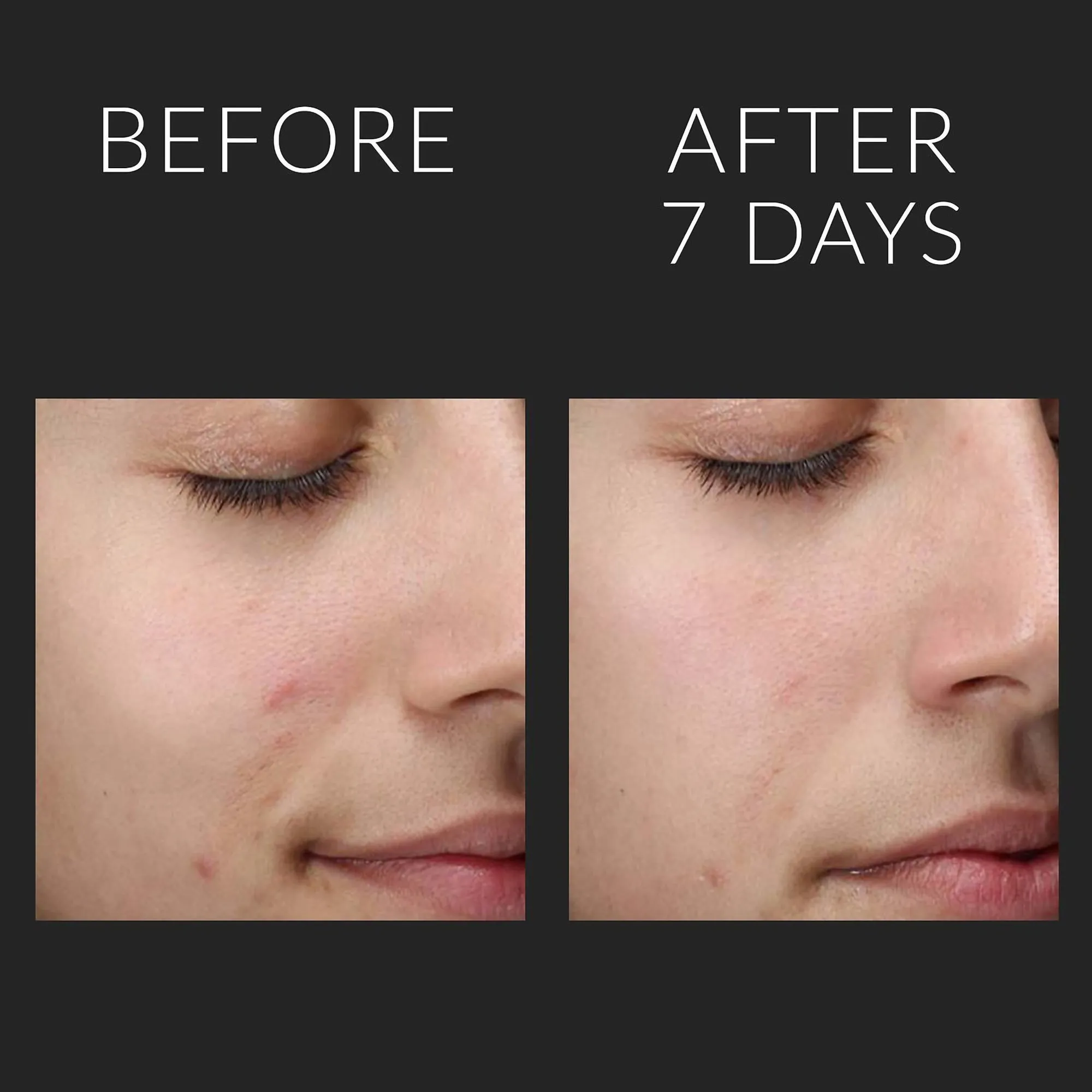 Kate Somerville Liquid ExfoliKate Triple Acid Resurfacing Treatment