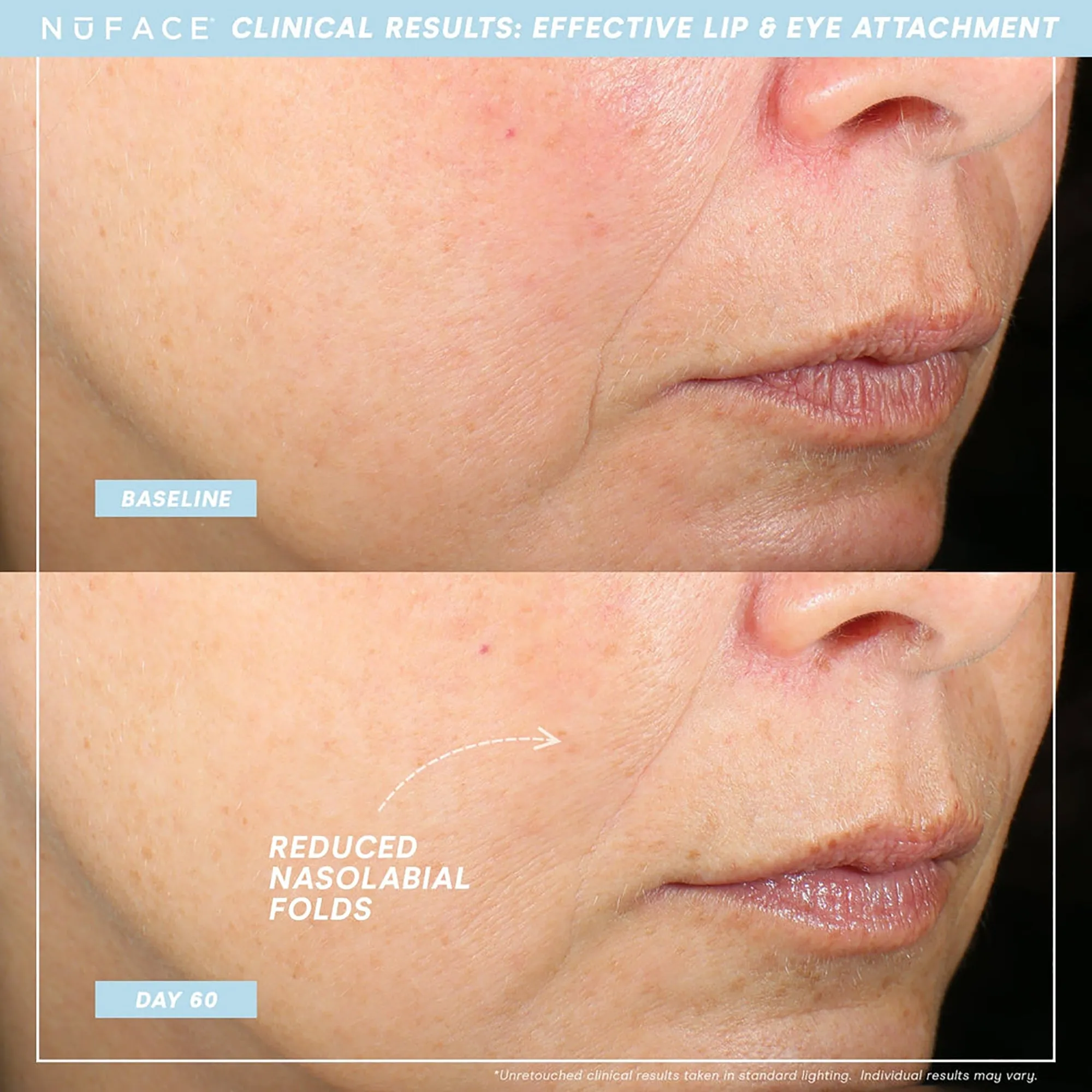 NuFace Trinity  Effective Lip & Eye Attachment