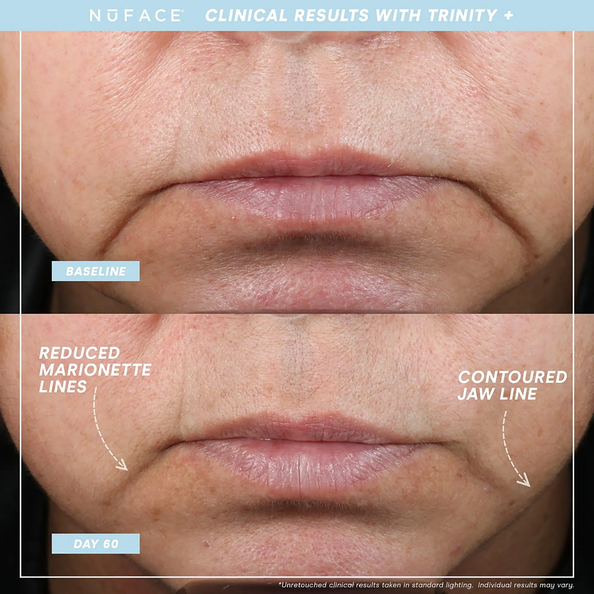 NuFace Trinity  WITH Effective Lip & Eye Attachment Kit