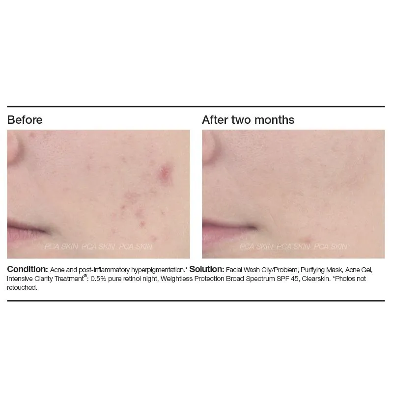 PCA Skin Acne Gel