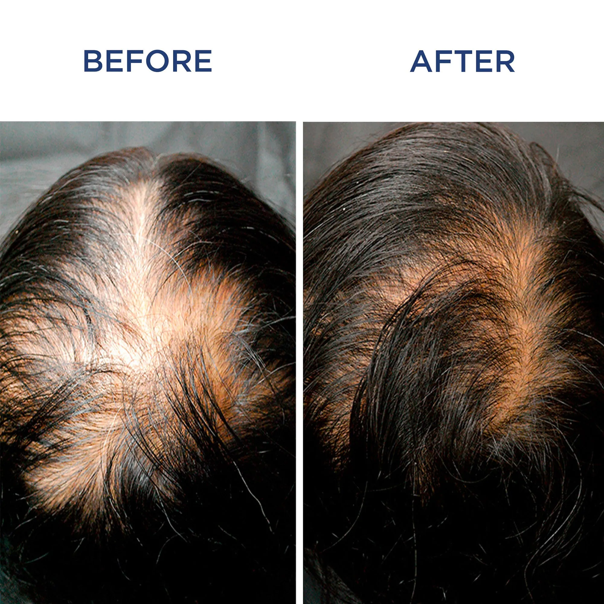 Phytocyane Women Treatment Progressive Hair Thinning -12 Vials