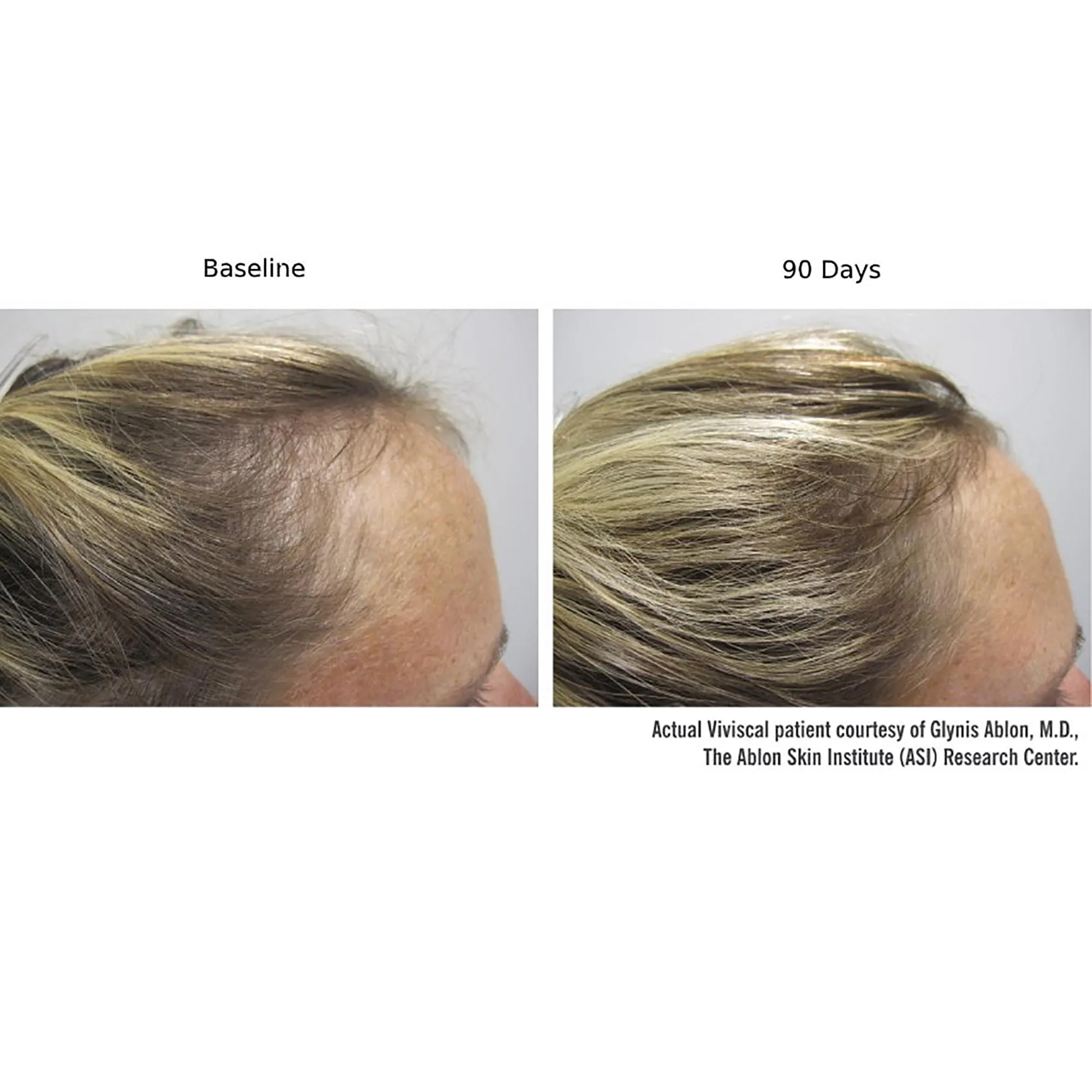 Viviscal Professional Advanced Hair Health Supplements